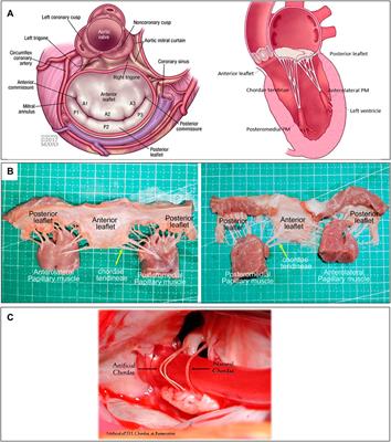 A review of the development of interventional devices for mitral valve repair with the implantation of artificial chords